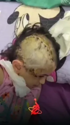 صهیونیست‌ها اینگونه پوست از سر دختر بیگناه در غزه کنده‌ان