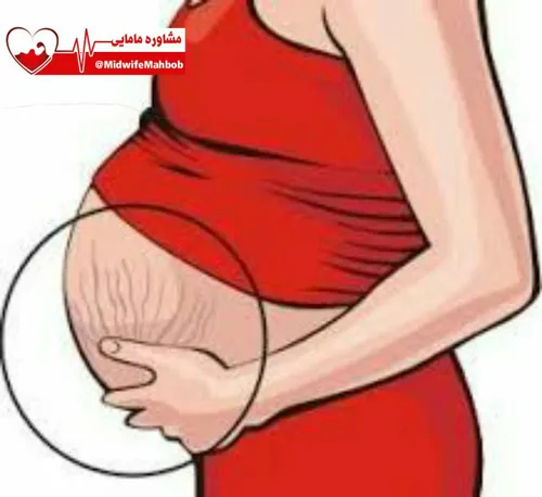 💢 برای جلوگیری از ترک خوردن شکم دوران بارداری از همان زما