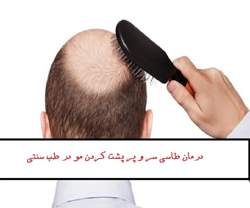 درمان طاسی سر و پر پشت کردن مو در طب سنتی