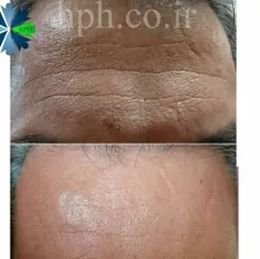 سرم صورت ضد چروک حاوی ذرات طلای 24 عیار بلک بری 40 میلی‌ل