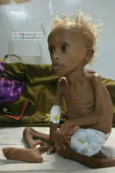 ⭕ ️ تصویر دلخراش و تکان دهنده از طفل یمنی که دچار سو تغذی