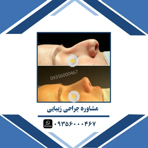 ⚜️ جراحی زیبایی بینی ⚜️