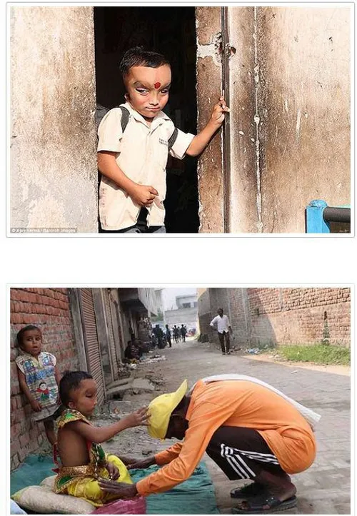 پرانشو پسر بچه 6 ساله هندی است که به علت ابتلا به بیماری 