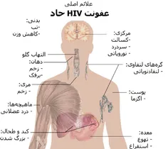 عفونت حاد HIV (ویروس ایدز) 