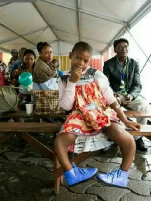 دختر 12ساله اهل کامرون، بخاطر بیماری ژنتیکی پاهاش گرد بود