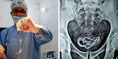 😷 جراحان از مثانه یک مرد هندی شارژر موبایل بیرون کشیدند!