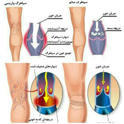 واریس چیست؟ وقتی که جریان گردش خون به درستی انجام نشود ، 