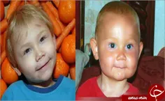پسری که با خوردن هویج پوستش نارنجی می‌شود.