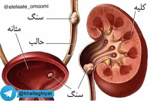 شکر عامل ایجاد سنگ کلیه و سنگ مثانه است و همچنین شکر باعث