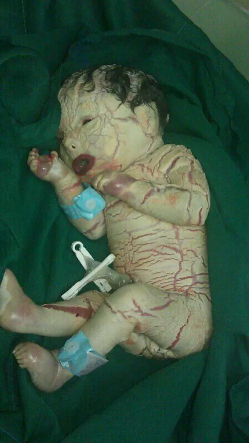 تولد نوزاد بدون پوست در شوش - باشگاه خبرنگاران جوان www.y