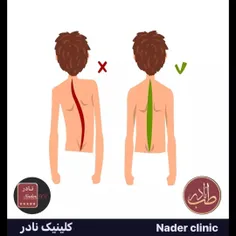 انحراف طرفی استخوان های ستون فقرات  همیشه نمایان نیست و د