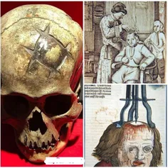 این جمجمه متعلق به 1600 سال پیش است که به عنوان یک جراحی 