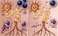 علائم بیماری " ام اس" چیست؟
