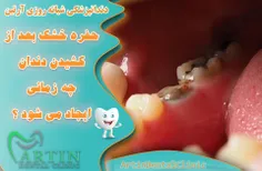 حفره خشک بعد از کشیدن دندان چه زمانی ایجاد می شود؟