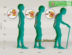 عوامل ایجاد پوکی استخوان‌