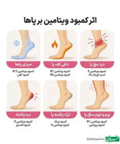 ♦️اثر کمبود ویتامین‌ها بر پاها🦶