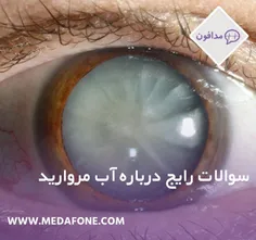 سوالات رایج درباره آب مروارید