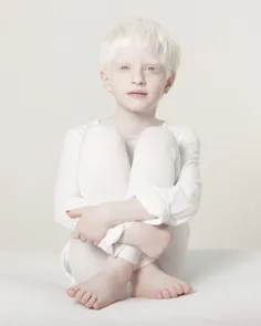 زالی یا آلبینیسم (به فرانسوی: Albinisme) نوعی بیماری ژنتی