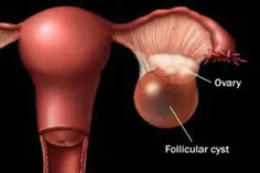 علل متفاوتی می‌تواند باعث بروز  کیست‌ تخمدان شود