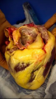 عکس قلب شخص چاق فوت شده در اثر سکته قلبی ، چربی های دور ق
