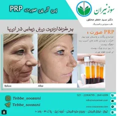 پی آر پی صورت PRP