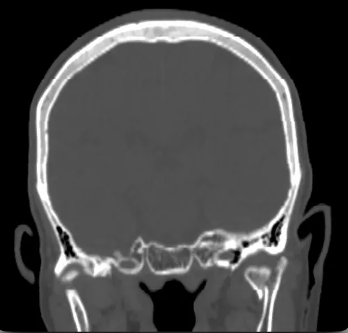 Mandibular condylar process fracture
