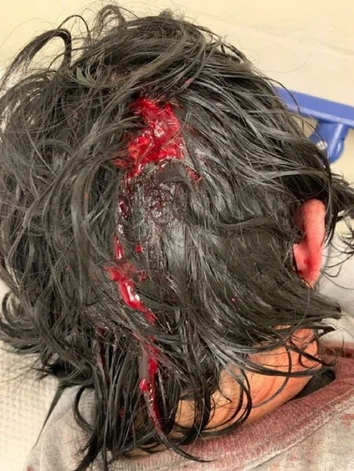 📸 جراحت شدید دانشجوی UCLA از ناحیه سر بر اثر شلیک گلوله پ