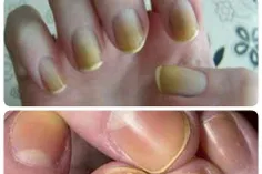 لکه های زرد ناخن را میتوانید با ترکیبی از خمیردندان و چند
