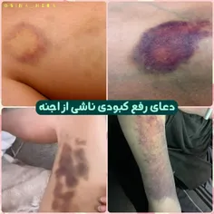 اگر روی بدن شما کبودی افتاد و بعد از مراجعه به پزشک علت آ