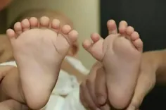 نوزاد 31 انگشتی پزشکان چینی در تلاشند طی سه مرحله جراحی ق