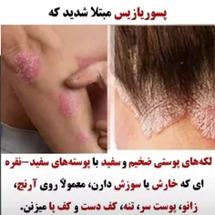 پسوریازیس و روغن آرگان و کره بدن آرگان بهمراه کرم میموزا