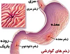 زخم معده !