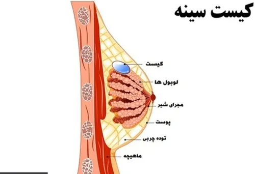 📌کیست سینه چی هست؟ 👇