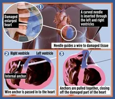 درمان بافت آسیب‌دیده قلب با روش جدید نخ‌کشی :