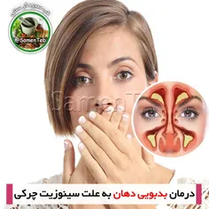 درمان بدبویی دهان به علت سینوزیت چرکی