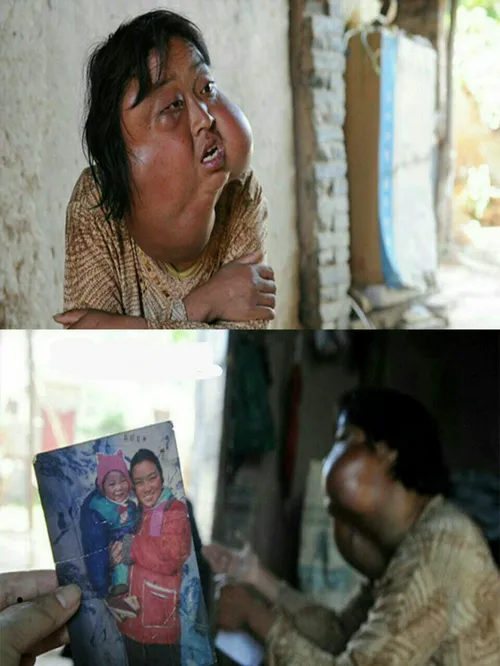 بیماری این زن چینی موجب شده است تا هفت غده بزرگ در 10 سال