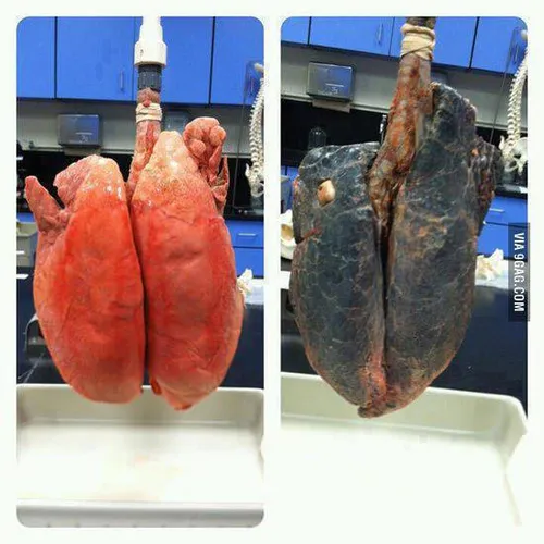 تفاوت ریه ی فرد سیگاری و غیر سیگاری!