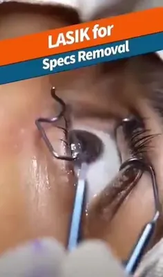 لیزیک نوعی عمل جراحی چشم است که به منظور رفع عیوب انکساری