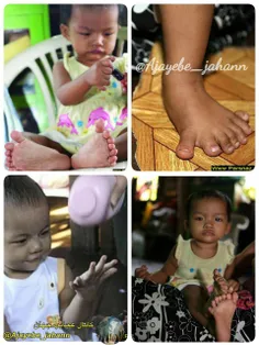 نوزاد بیست و شش انگشتی میانماری در کتاب رکوردهای گینس ثبت