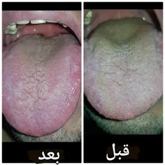 اینم نتیجه درمان یکی از مراجعانمون از روی عکس زبانشون