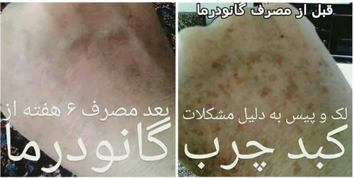 ☕ ️ مصرف ۶ هفته ای گانودرما و از بین رفتن لک پوستی به دلی