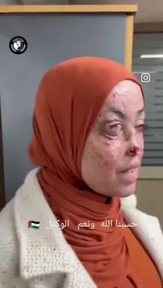 دختر فلسطینی قربانی بمباران صهیونیست ها با سلاح های فسفر 
