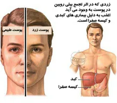 مهمترین علت زردی پوست، سرطان کبدوکیسه صفرا است !