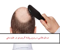 درمان طاسی سر و پر پشت کردن مو در طب سنتی