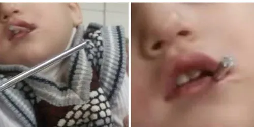 فرو رفتن میله فلزی در دهان کودک ۲ ساله