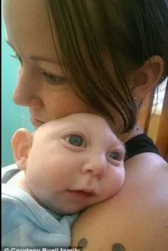 نوزاد آمریکایی که بر اثر یک نارسایی ژنتیکی قسمتی از مغزش 