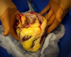 عکس قلب شخص چاق فوت شده در اثر سکته قلبی ! چربی دور قلب ر