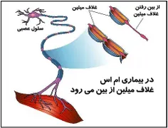 ***یک خبر خوب برای کسانی که ام  MS دارند***
