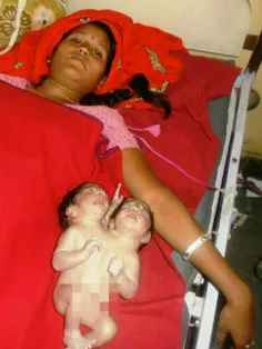 مادر 21 ساله هندی نوزادی با دو سر به دنیا آورد. او میگوید