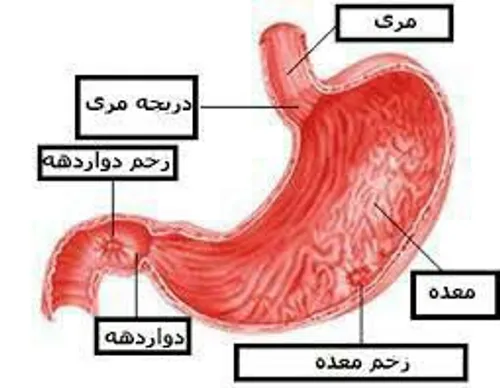 🔴 زخم معده